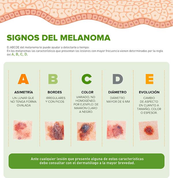 Signos para identificar las características del melanoma